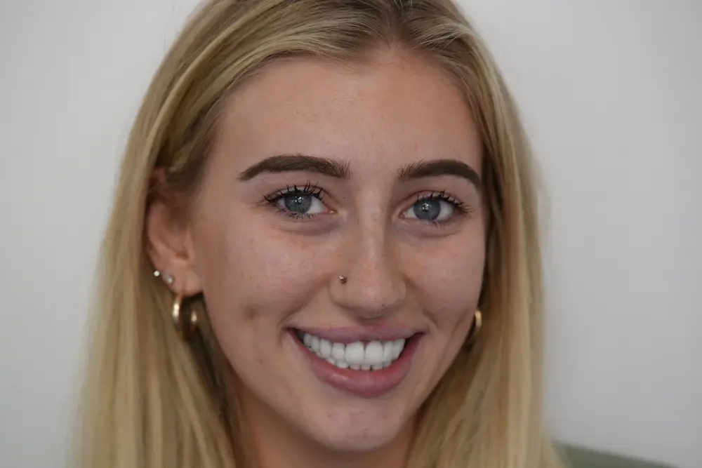 Same patient after minimal prep porcelain veneers