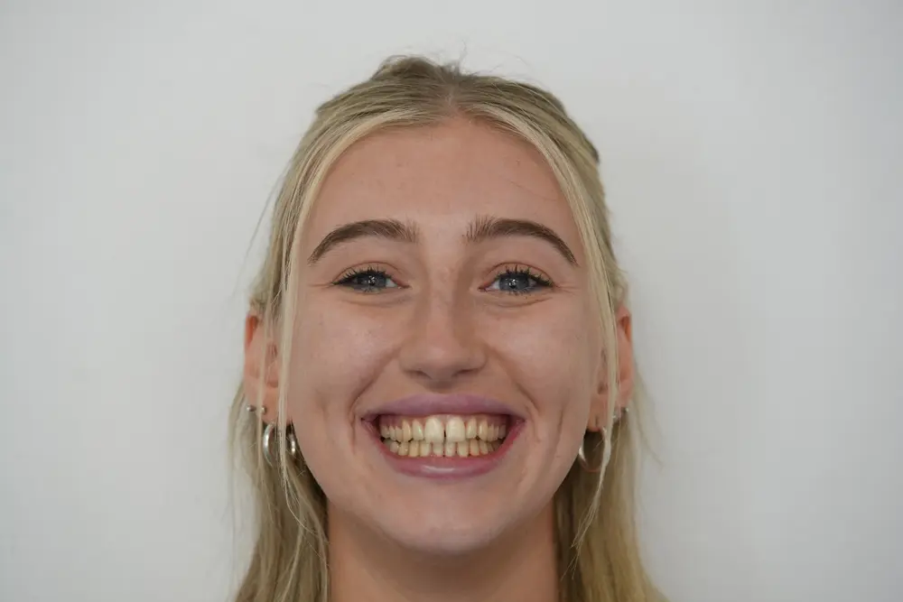 Patient smile before porcelain veneers