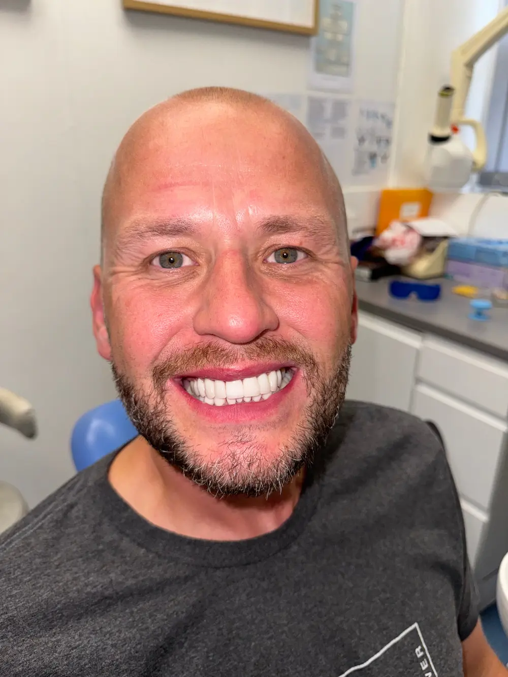 Same patient after minimal prep porcelain veneers