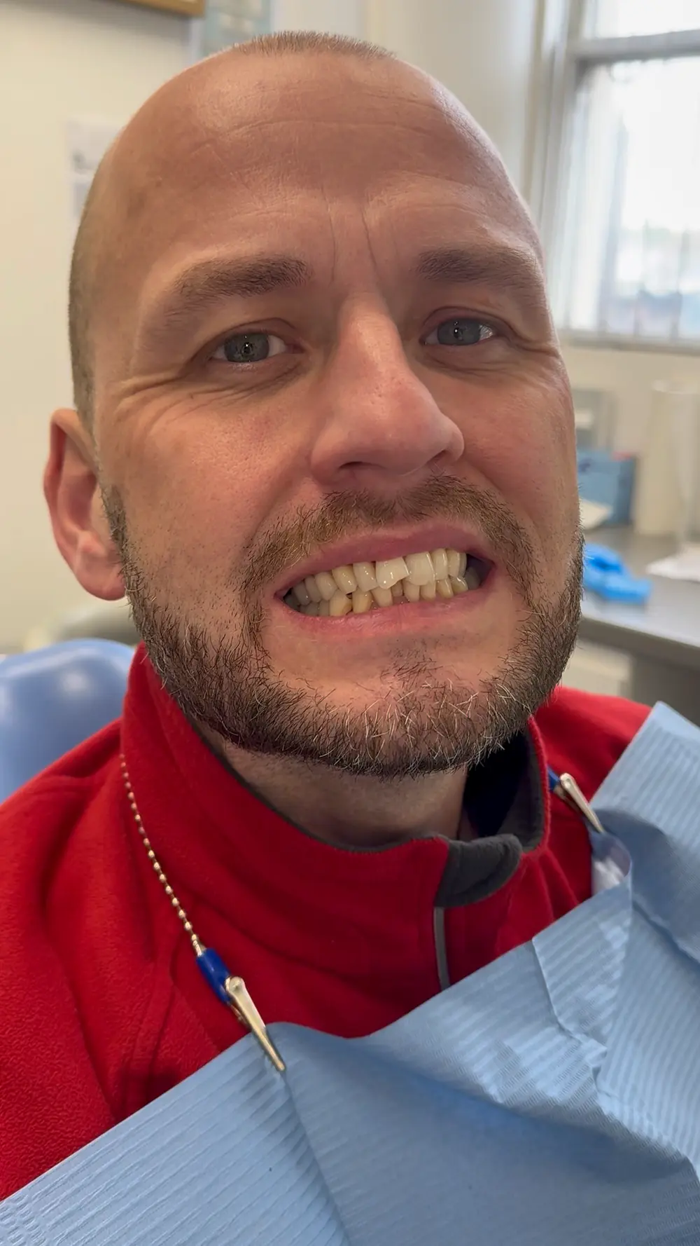 Patient smile before porcelain veneers