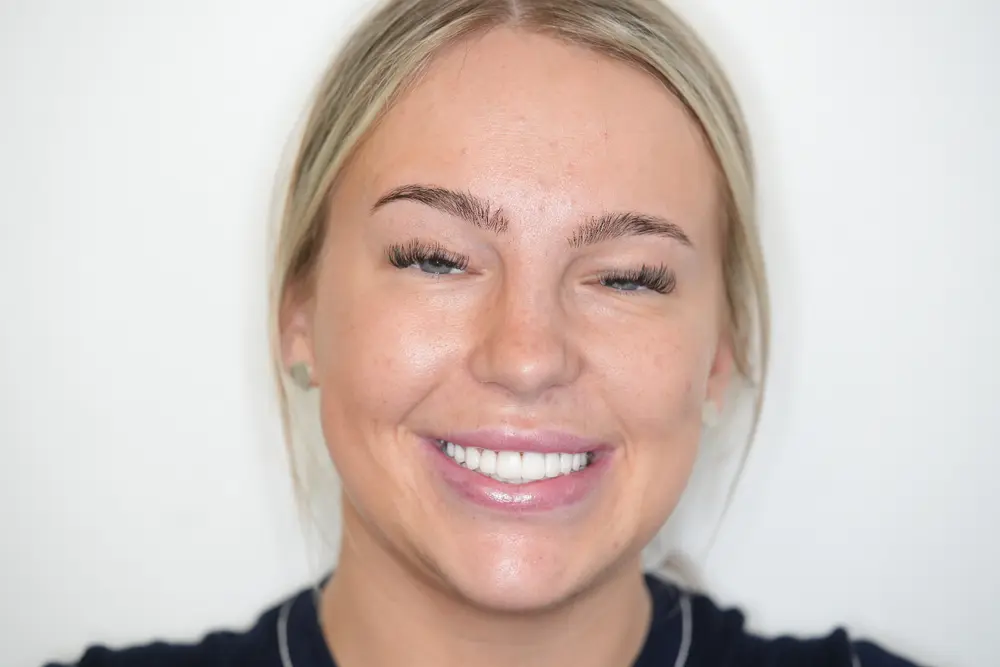 Same patient after minimal prep porcelain veneers