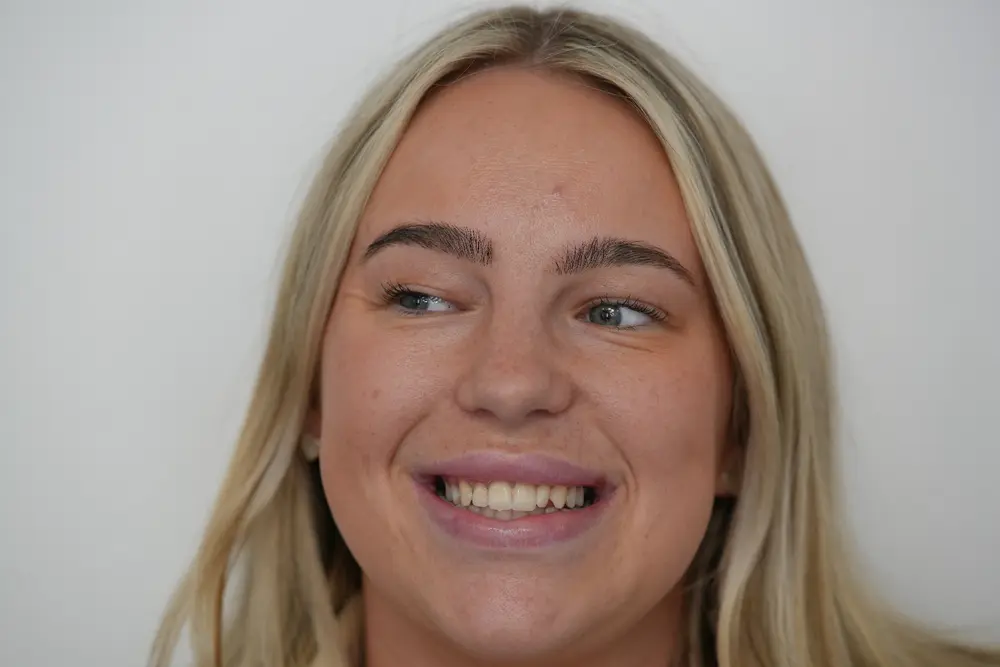 Patient smile before porcelain veneers