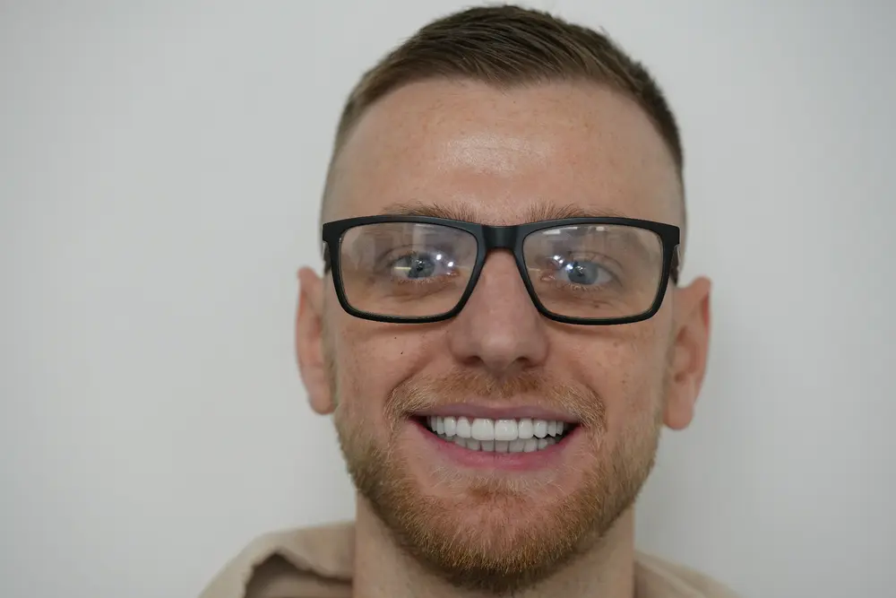 Same patient after minimal prep porcelain veneers