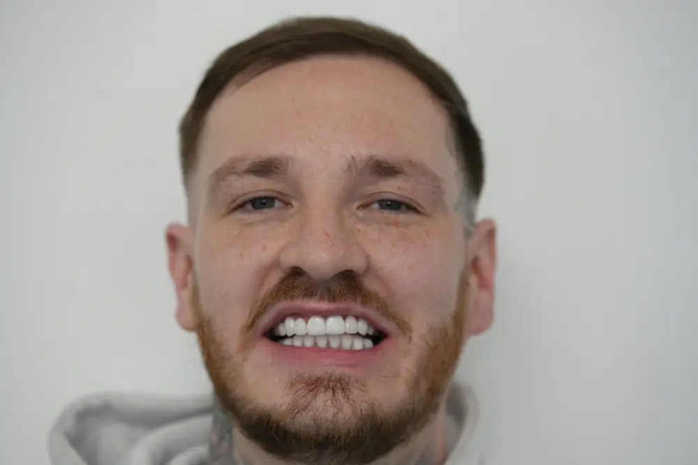 Same patient after minimal prep porcelain veneers
