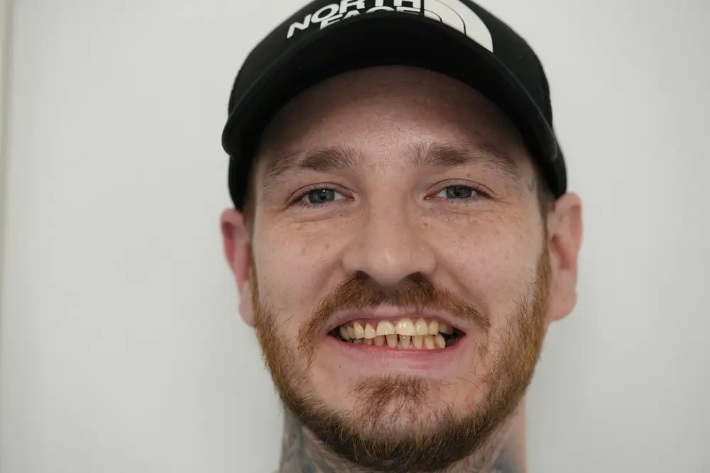 Patient smile before porcelain veneers